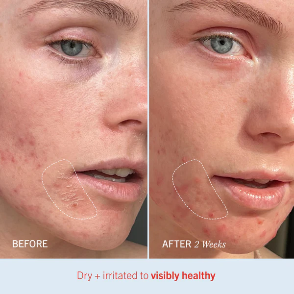 First Aid Beauty - Ultra Repair Cream, Intense Hydration Whipped Colloidal Oatmeal, Clinically Proven to Strengthen Skin Barrier in 7 Days & Helps Relieve Eczema, Luxury Face & Body Moisturizer, 14 fl oz/ 396.8g