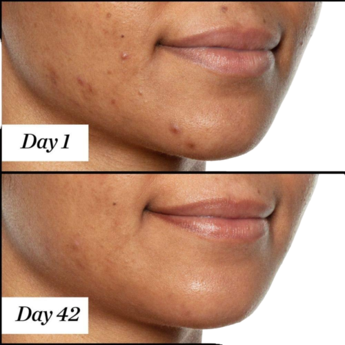 Sunday Riley U.F.O. Ultra-Clarifying Salicylic Acid and Tea Tree Acne Treatment Face Oil 15ml/ 0.5 fl oz