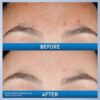 CeraVe Resurfacing Retinol Serum For Post Acne Marks, Formulated With Licorice Root Extract & Niacinamide, Brightening Serum & Pore Minimizer For Face, Post Acne Skin Barrier Repair, Non-Comedogenic 30ML /1FL OZ