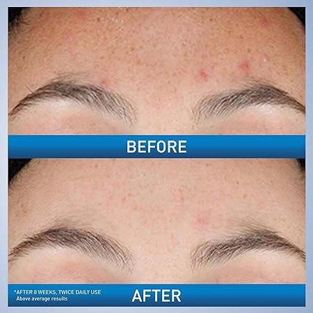 CeraVe Resurfacing Retinol Serum For Post Acne Marks, Formulated With Licorice Root Extract & Niacinamide, Brightening Serum & Pore Minimizer For Face, Post Acne Skin Barrier Repair, Non-Comedogenic 30ML /1FL OZ