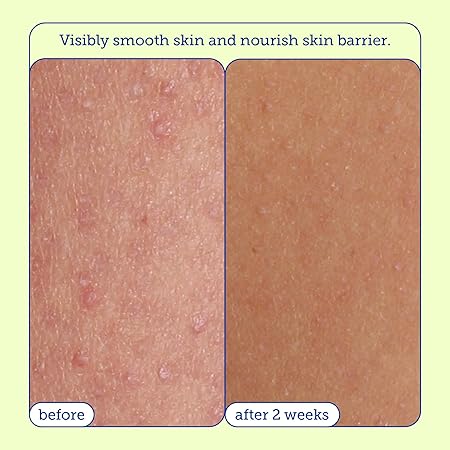 Skinfix Resurface+ AHA/BHA Renewing Cream: Exfoliating Body Cream That Visibly Smooths Rough, Bumpy & Crepey Skin While Moisturizing With Shea Butter, Jojoba Oil & Glycerin, 10 Fl Oz/ 296ml