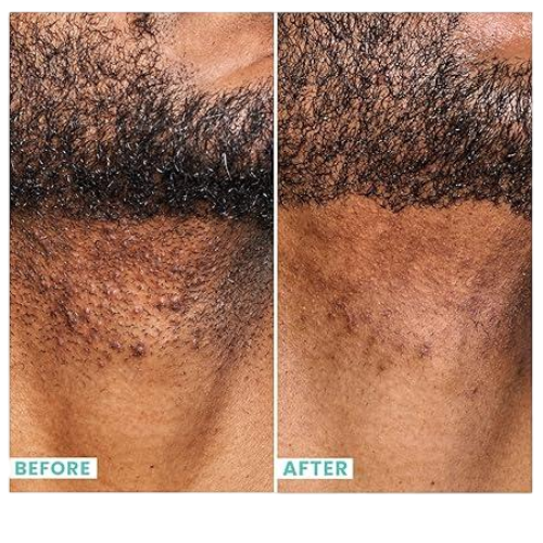 Daily Mens Exfoliating Face Wash + Scrub | Urban Skin Rx® | Powerful 2-in-1 Cleanser and Scrub | Cleans Pores of Dirt and Oil. Formulated with Salicylic Acid, Jojoba Beads and Niacinamide | 5.1 fl oz/ 150ml