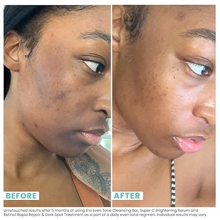 Urban Skin Rx Combination Skin Cleansing Bar | 3-in-1 Daily Cleanser, Exfoliator, and Mask Smooths, Hydrates, Improves the Appearance of Skin Tone + Texture, Formulated with Salicylic Acid | 2 Oz/ 56g