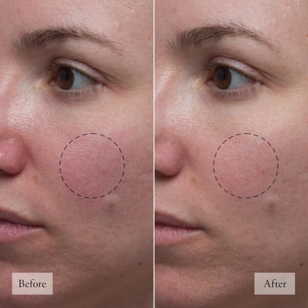 philosophy microdelivery resurfacing solution - with 4% ahas, cica & vitamin C - reduces the appearances of fine lines & pores - 5 fl oz / 150 ml