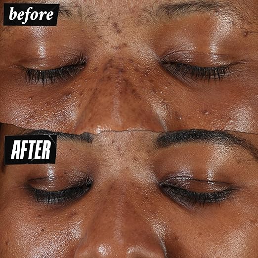 Kiehl's Clearly Corrective Dark Spot Serum, Brightening Facial Serum, Reduces Hyperpigmentation & Post-acne Marks, with Vitamin C & Salicylic Acid, All Skin Types, Paraben-free, Mineral Oil-free 1.7 fl oz/ 50ml
